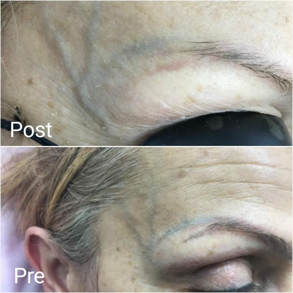 إزالة تاتو الحواجب بالليزر